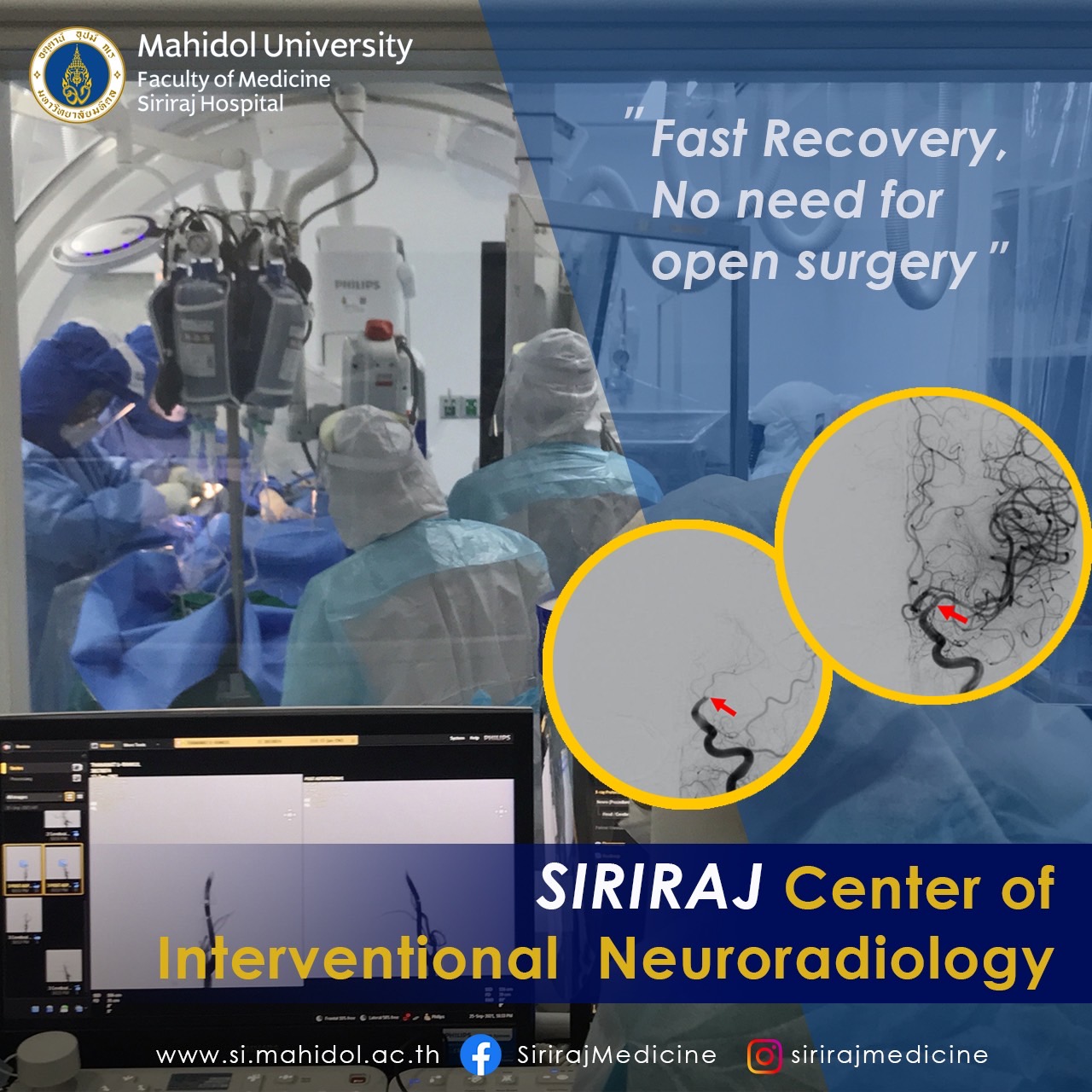 Siriraj – Center of interventional neuroradiology