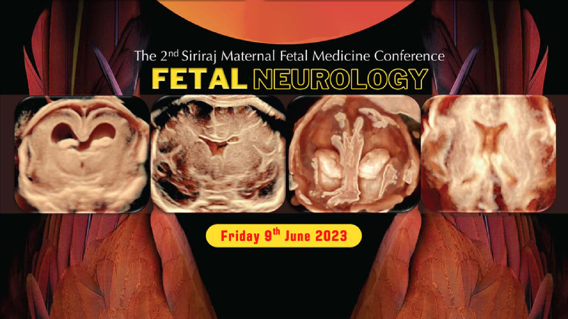 The 2nd Siriraj Maternal Fetal Medicine Conference FETAL NEUROLOGY