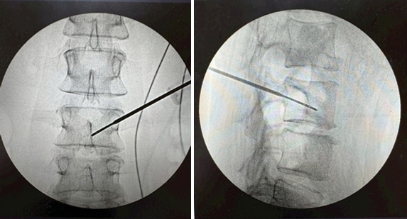 รูปที่1: Modic type1 change (ในT1 sequence) ที่ end plate ของ กระดูก L3 และ L4 รูปที่1: Modic type1 change (ในT1 sequence) ที่ end plate ของ กระดูก L3 และ L4