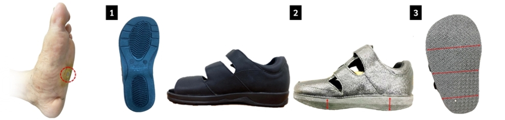 Charcot_Foot